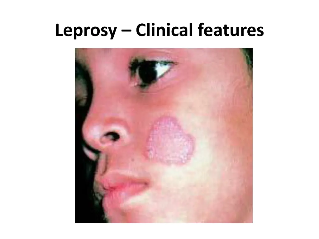 leprosy clinical features