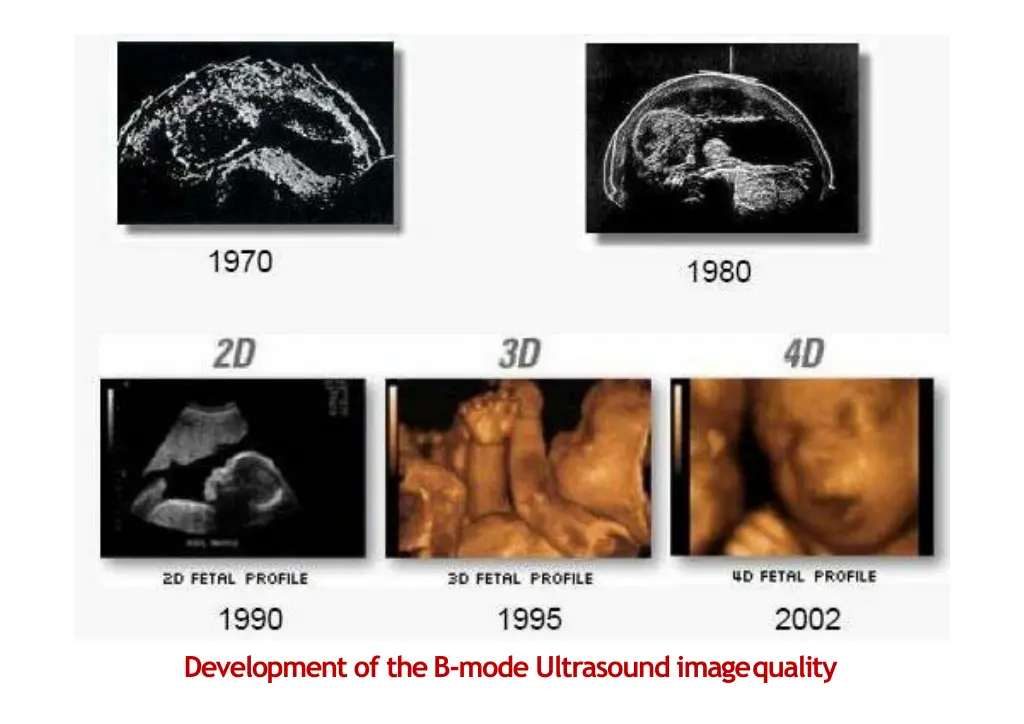 development of the b mode ultrasound imagequality