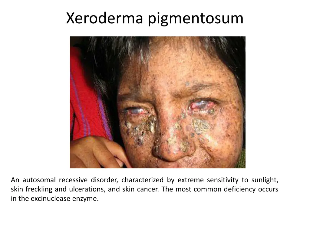 xeroderma pigmentosum