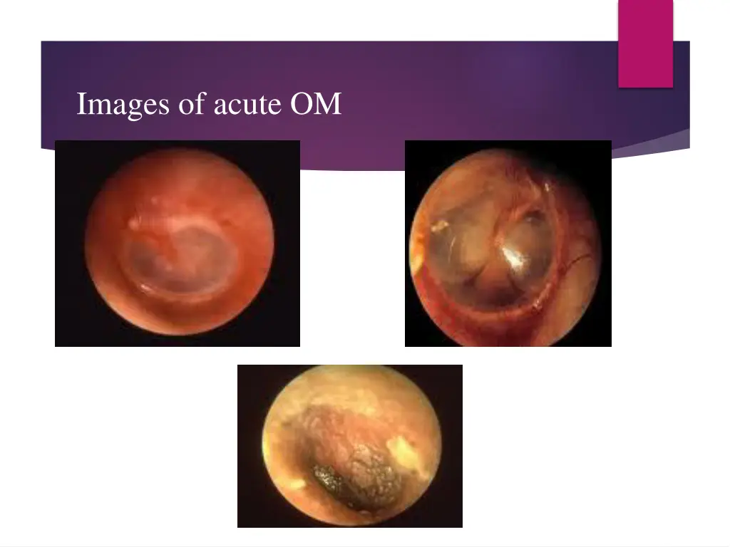 images of acute om