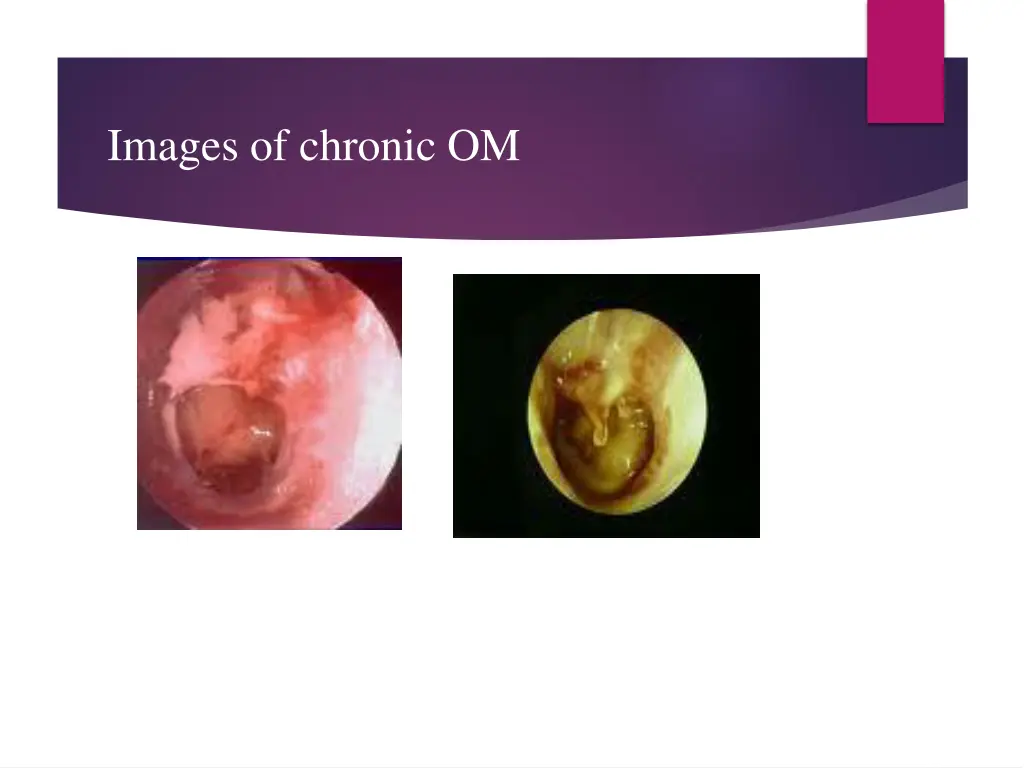 images of chronic om