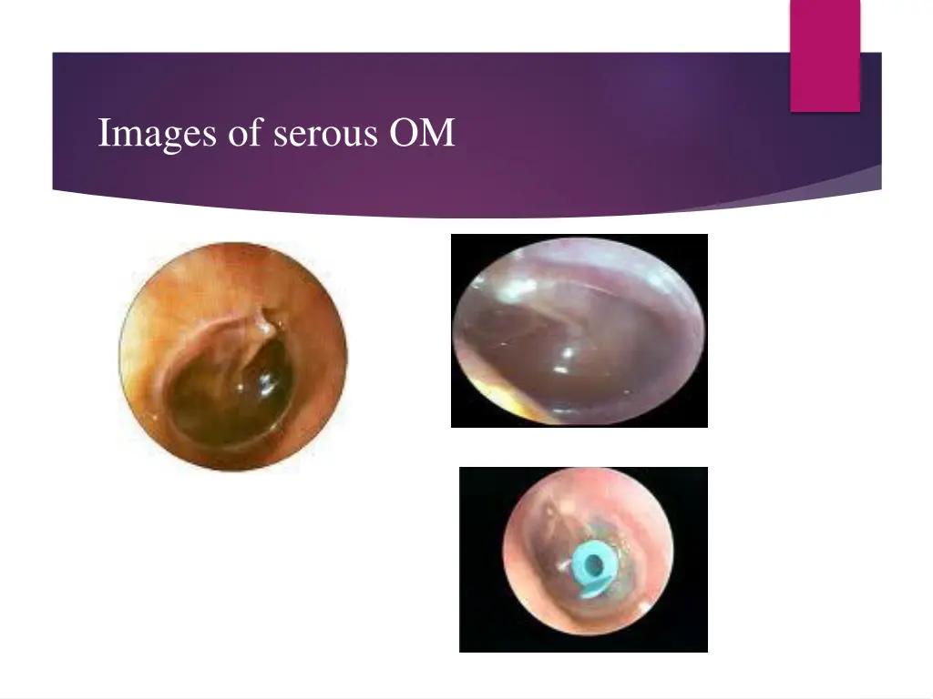 images of serous om