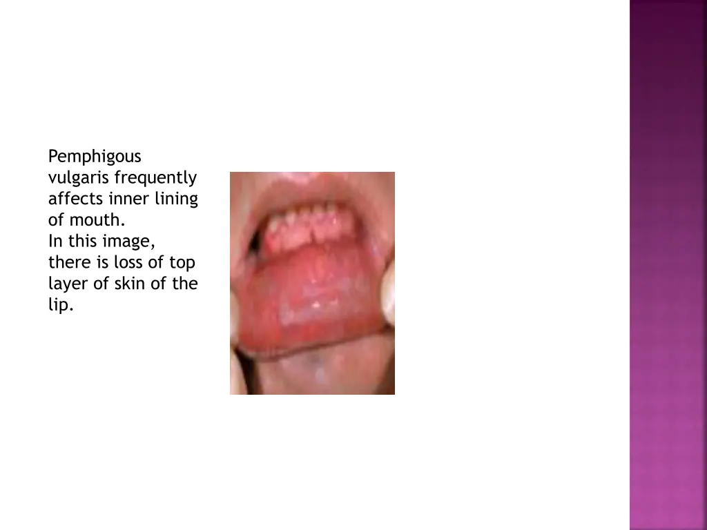 pemphigous vulgaris frequently affects inner
