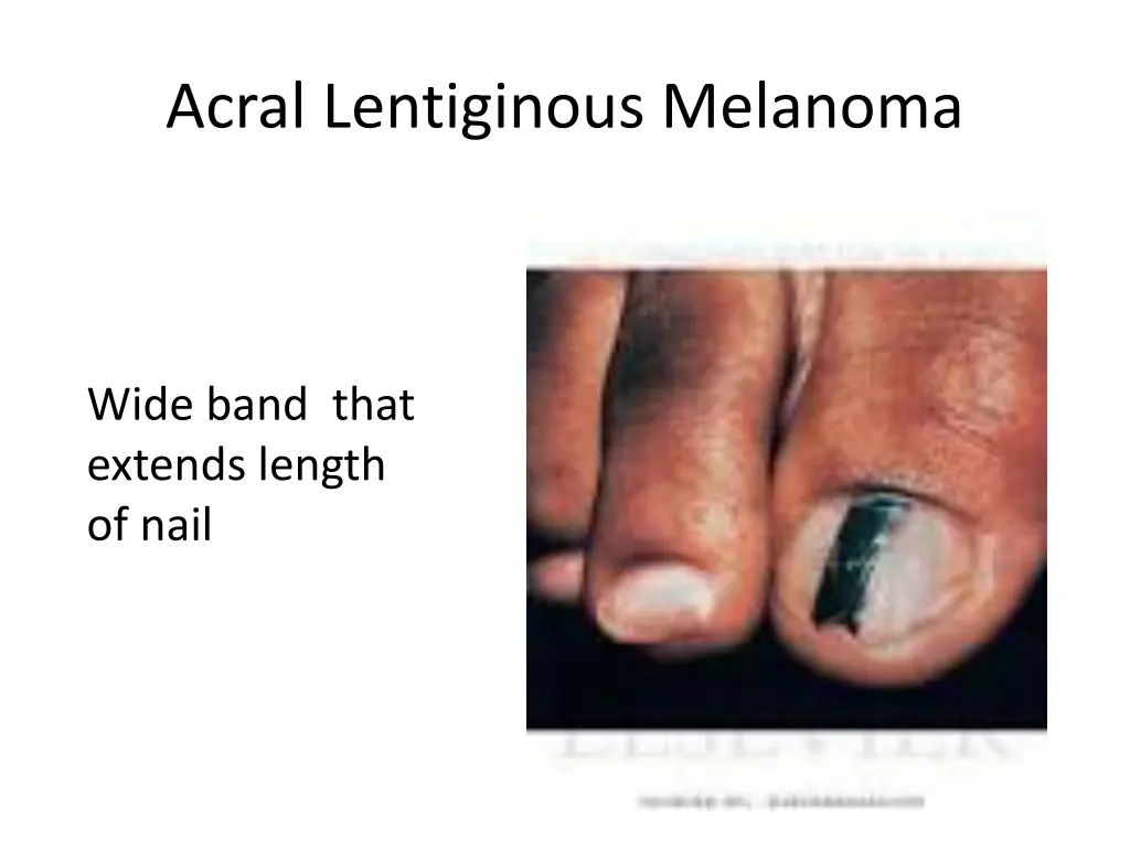 acral lentiginous melanoma