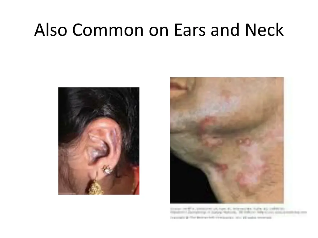 also common on ears and neck