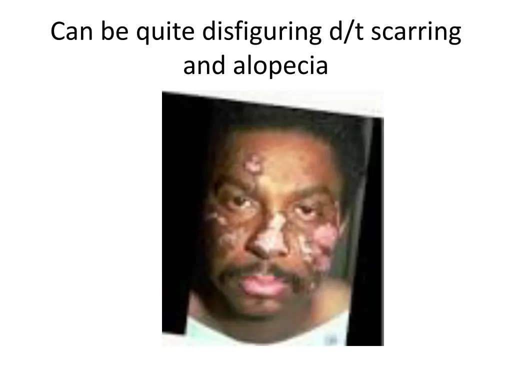 can be quite disfiguring d t scarring and alopecia