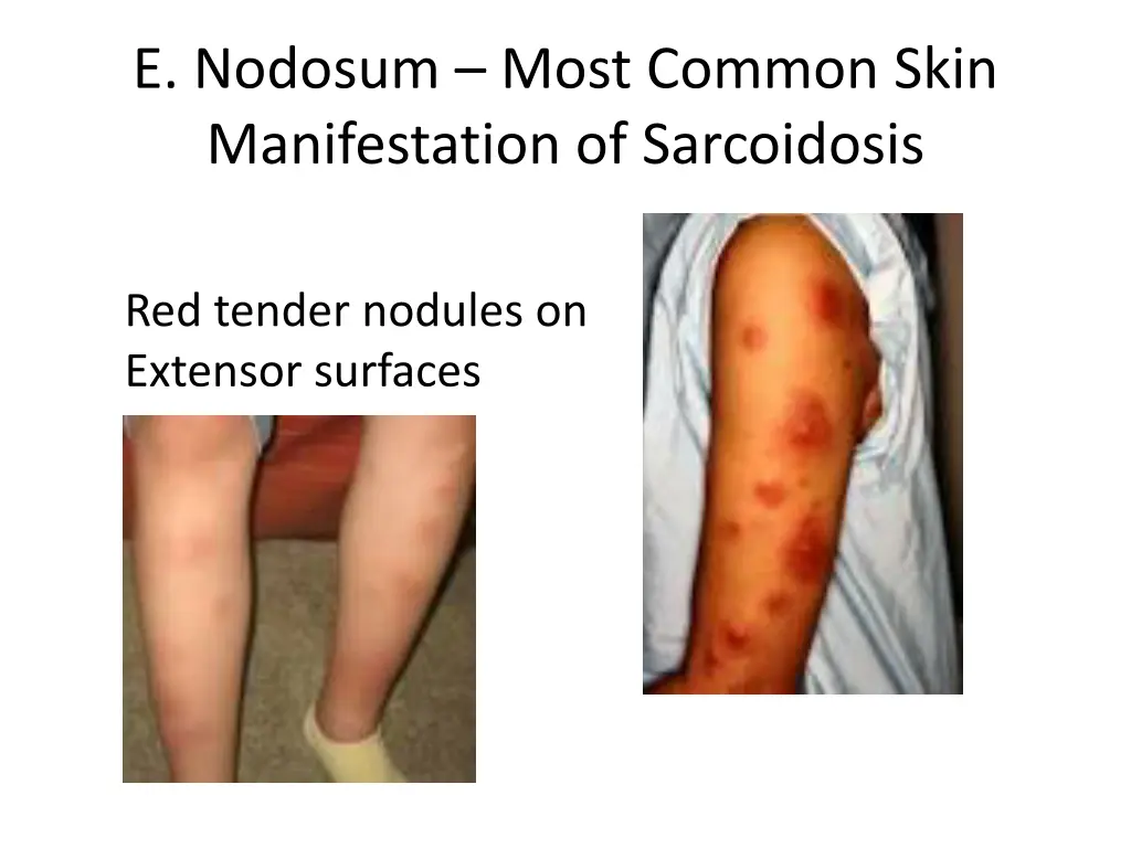e nodosum most common skin manifestation