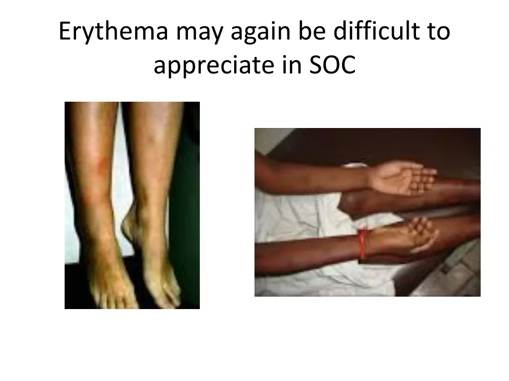 erythema may again be difficult to appreciate