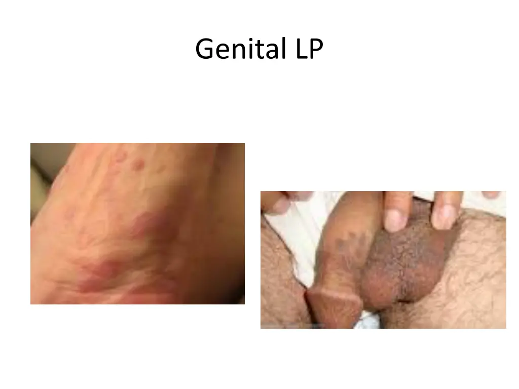 genital lp