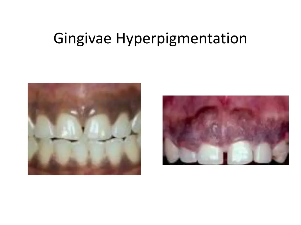 gingivae hyperpigmentation