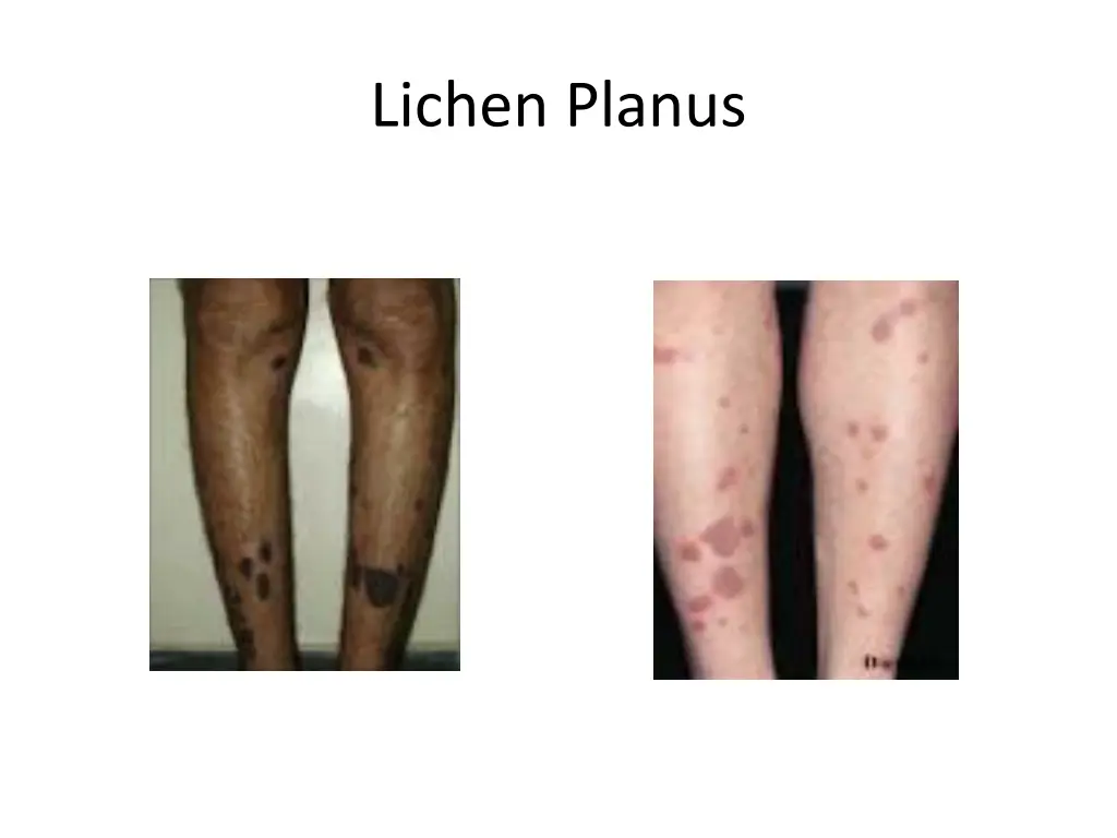 lichen planus 1