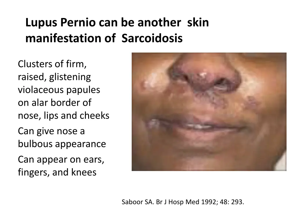 lupus pernio can be another skin manifestation