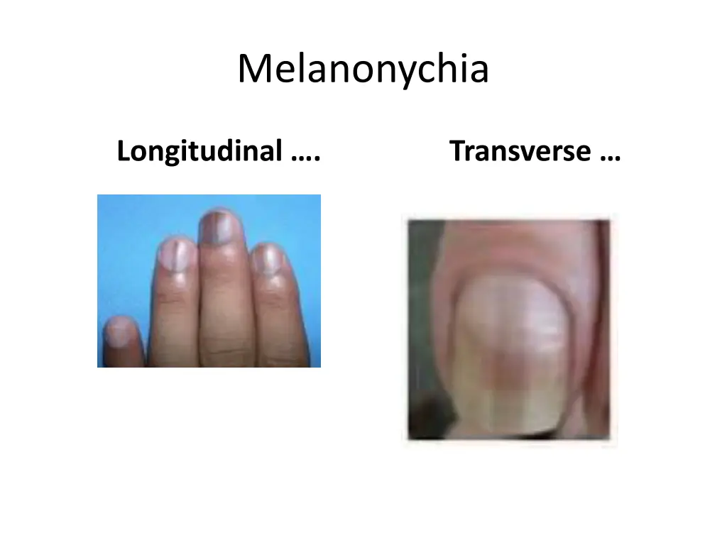melanonychia