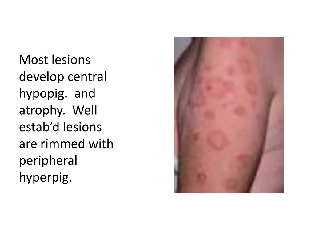most lesions develop central hypopig and atrophy