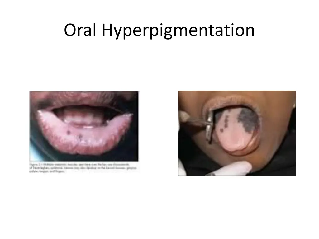oral hyperpigmentation 1