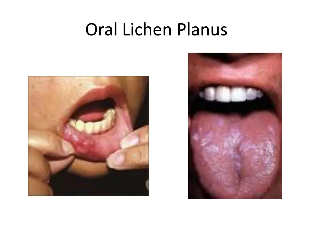 oral lichen planus