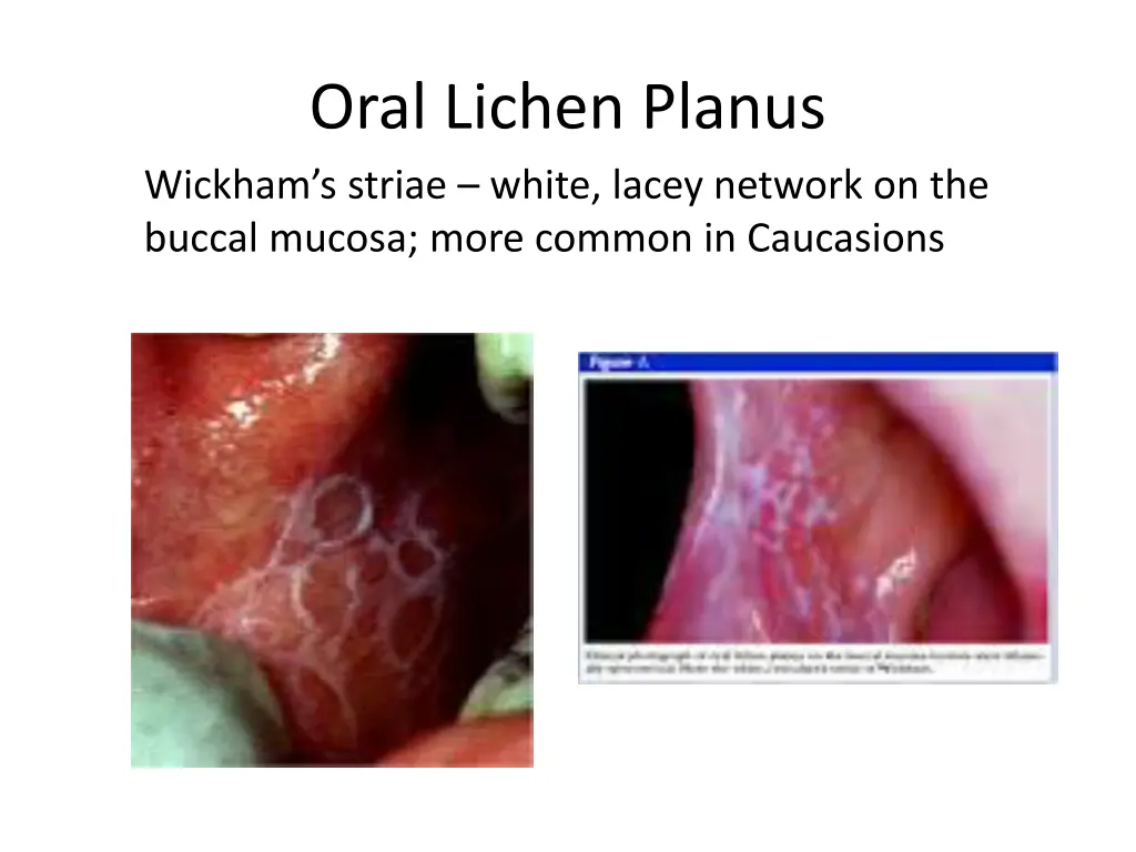 oral lichen planus wickham s striae white lacey
