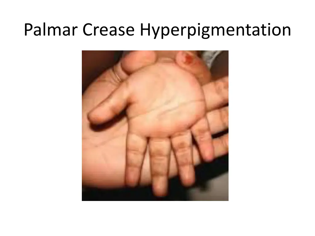 palmar crease hyperpigmentation 1