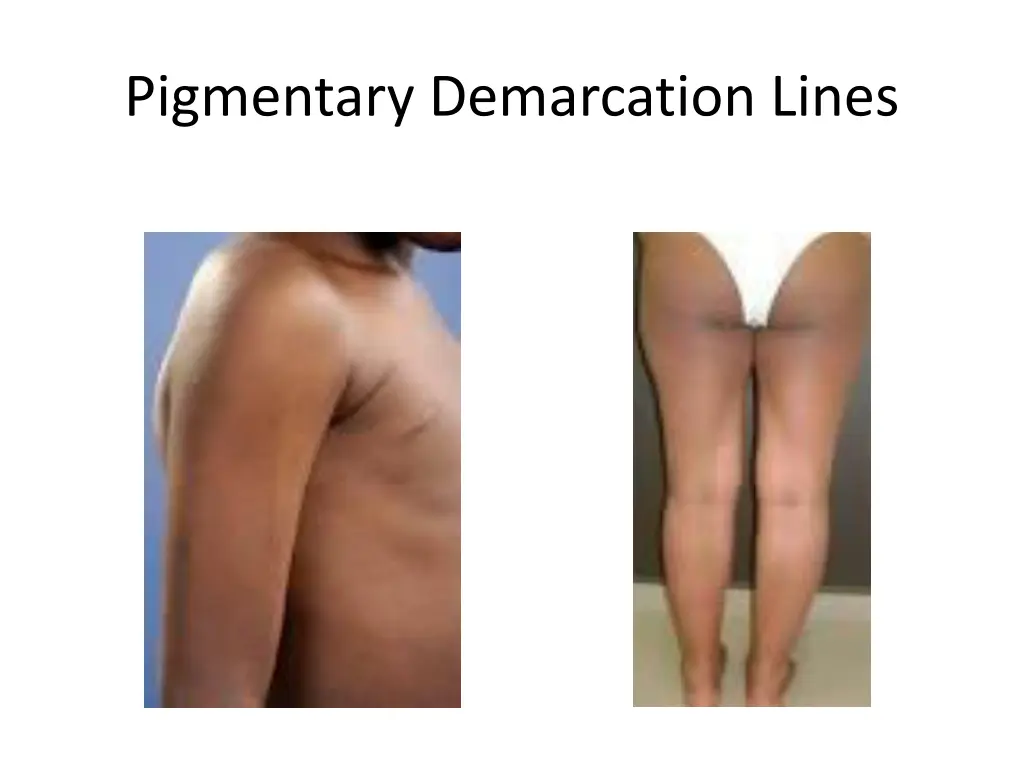 pigmentary demarcation lines 1