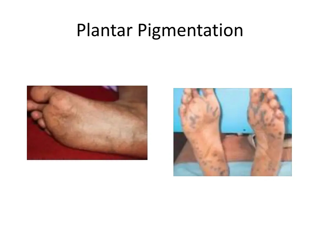 plantar pigmentation 1