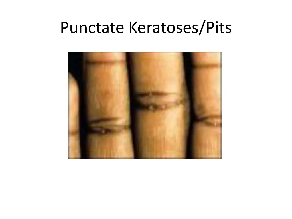 punctate keratoses pits