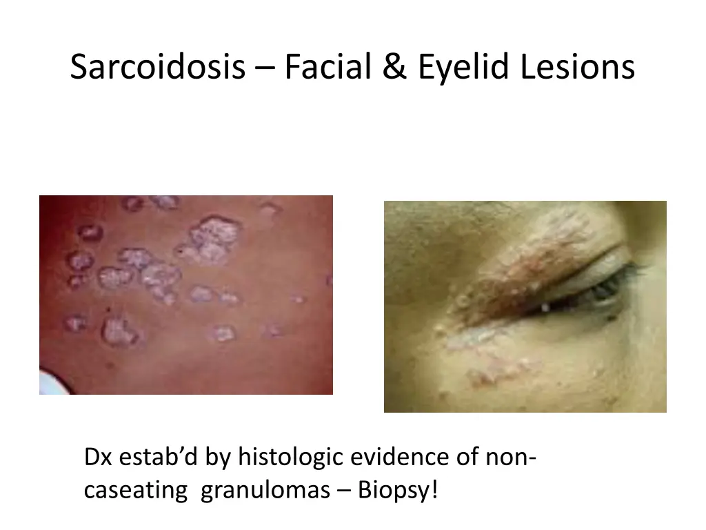 sarcoidosis facial eyelid lesions