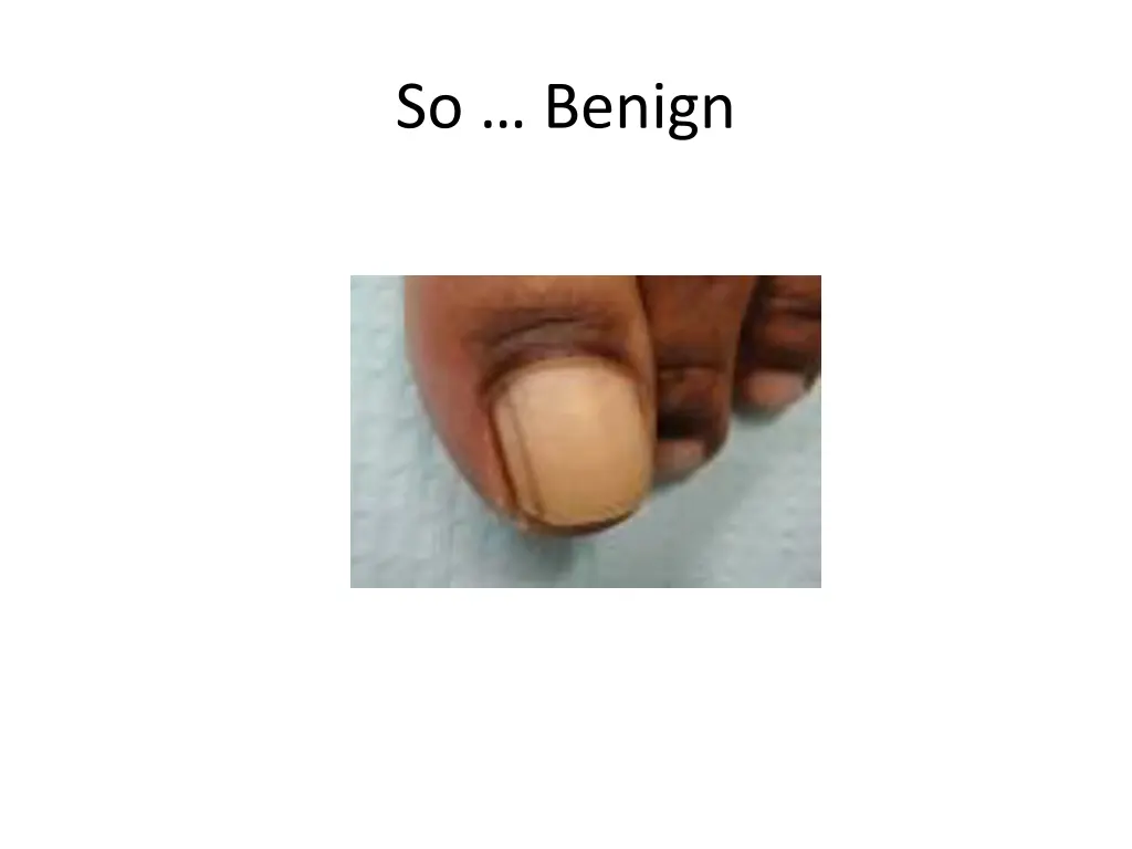 so benign