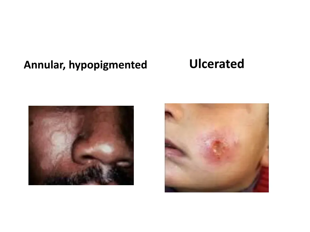ulcerated