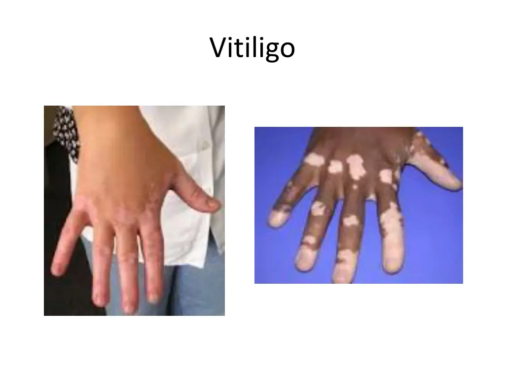 vitiligo 2