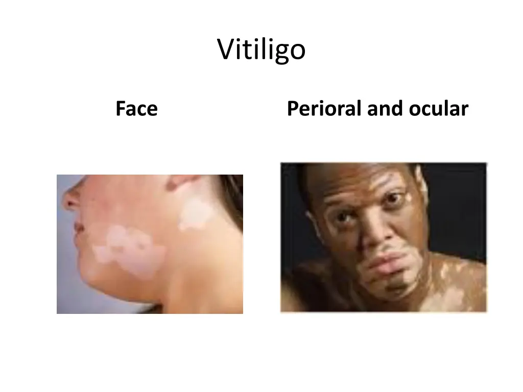 vitiligo