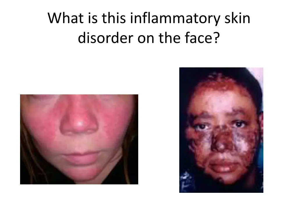 what is this inflammatory skin disorder