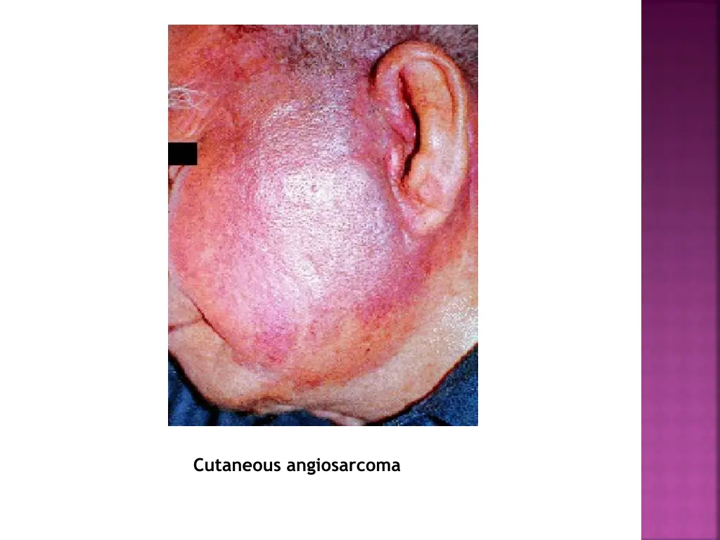 cutaneous angiosarcoma