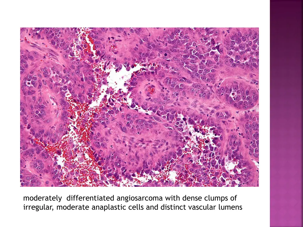 moderately differentiated angiosarcoma with dense