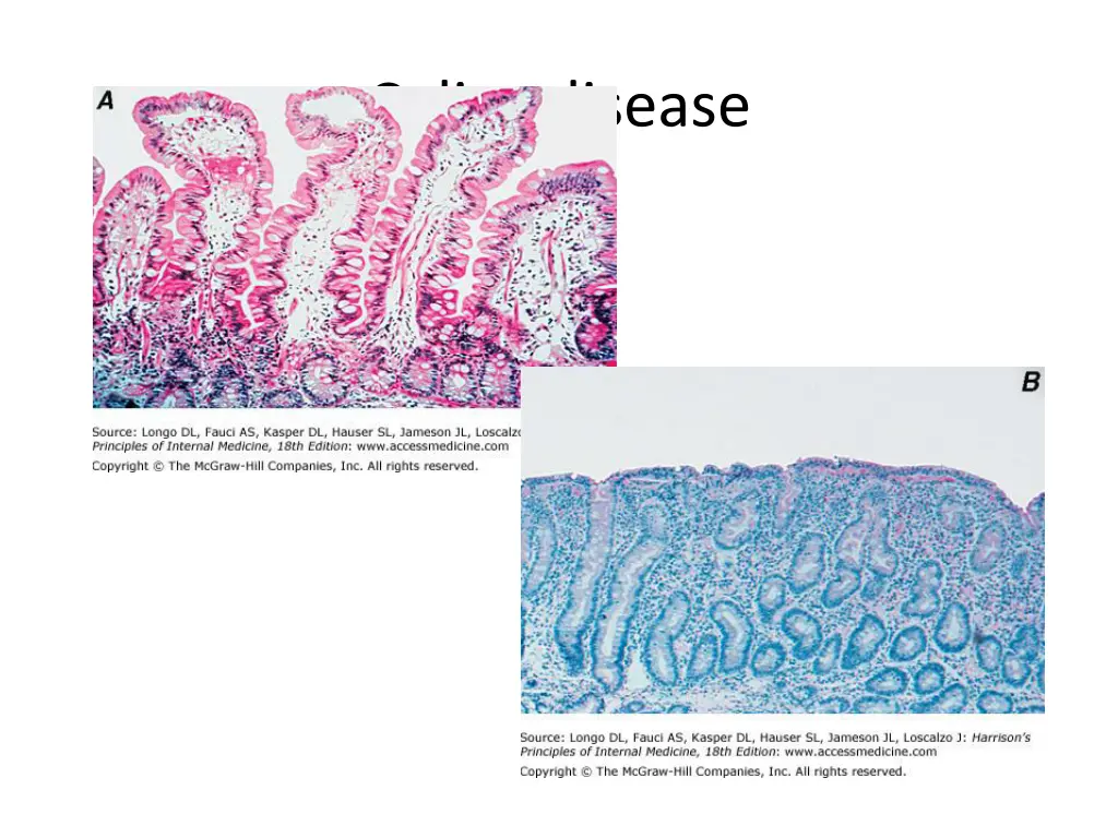 celiac disease 1