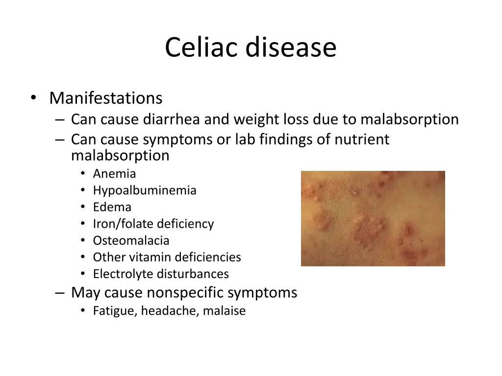 celiac disease 2