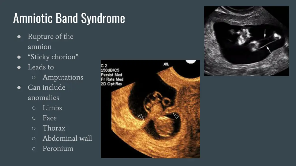 amniotic band syndrome