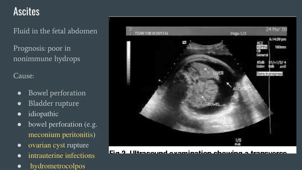 ascites