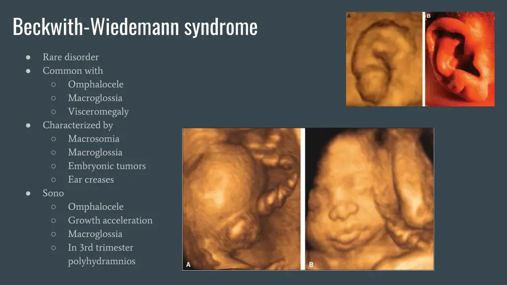 beckwith wiedemann syndrome