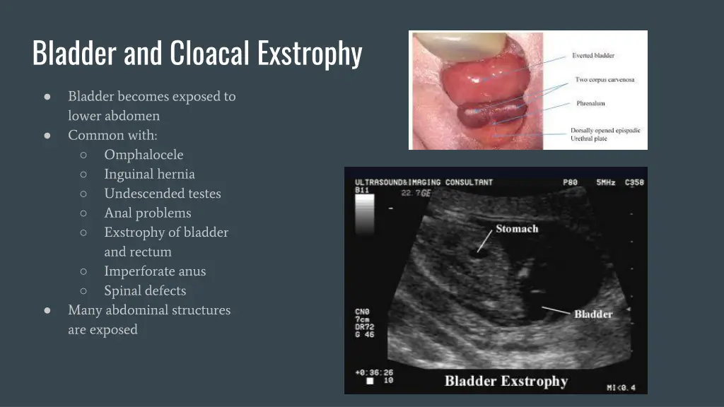bladder and cloacal exstrophy