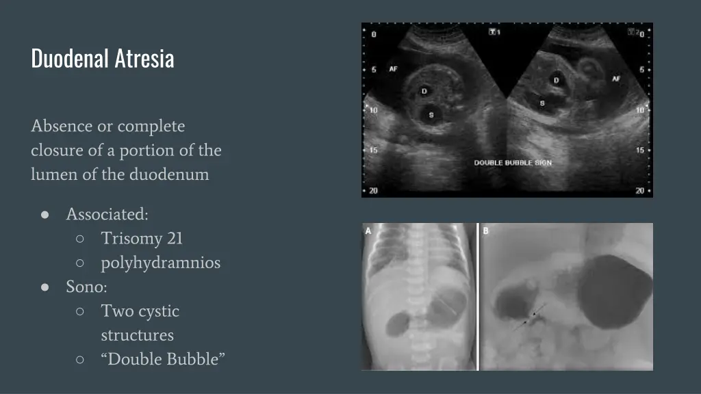 duodenal atresia