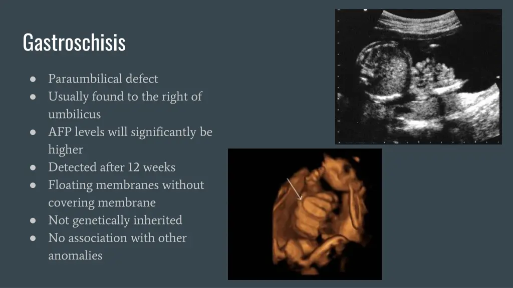 gastroschisis
