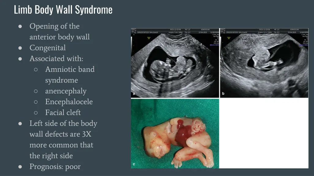 limb body wall syndrome