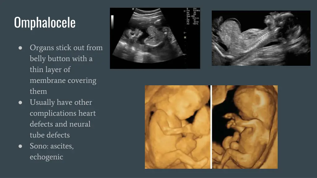omphalocele