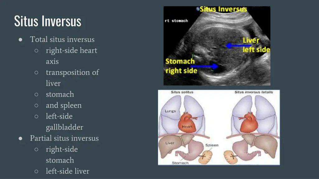 situs inversus
