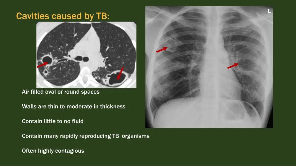 cavities caused by tb