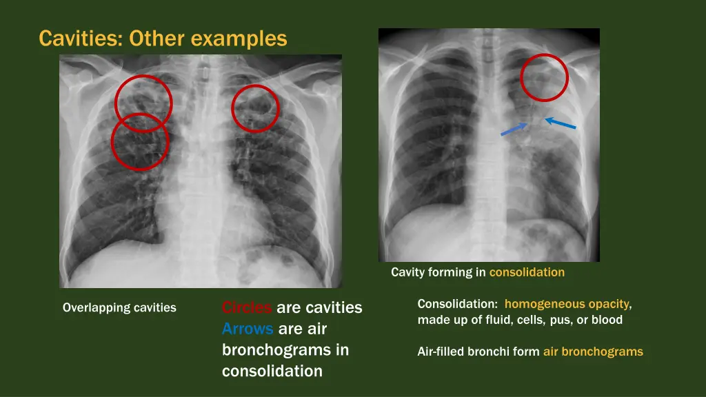 cavities other examples