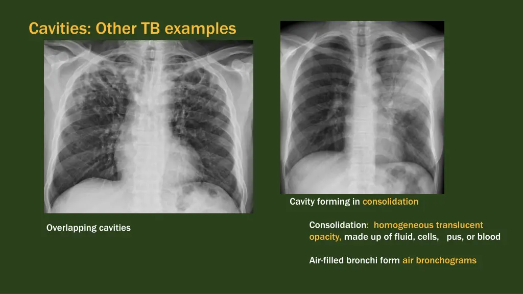 cavities other tb examples