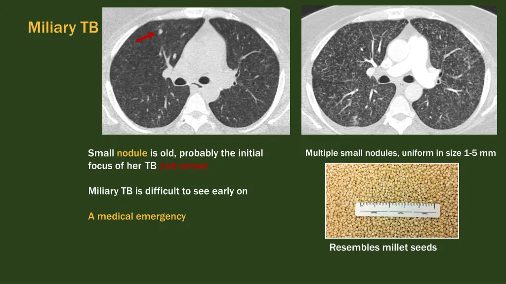 miliary tb