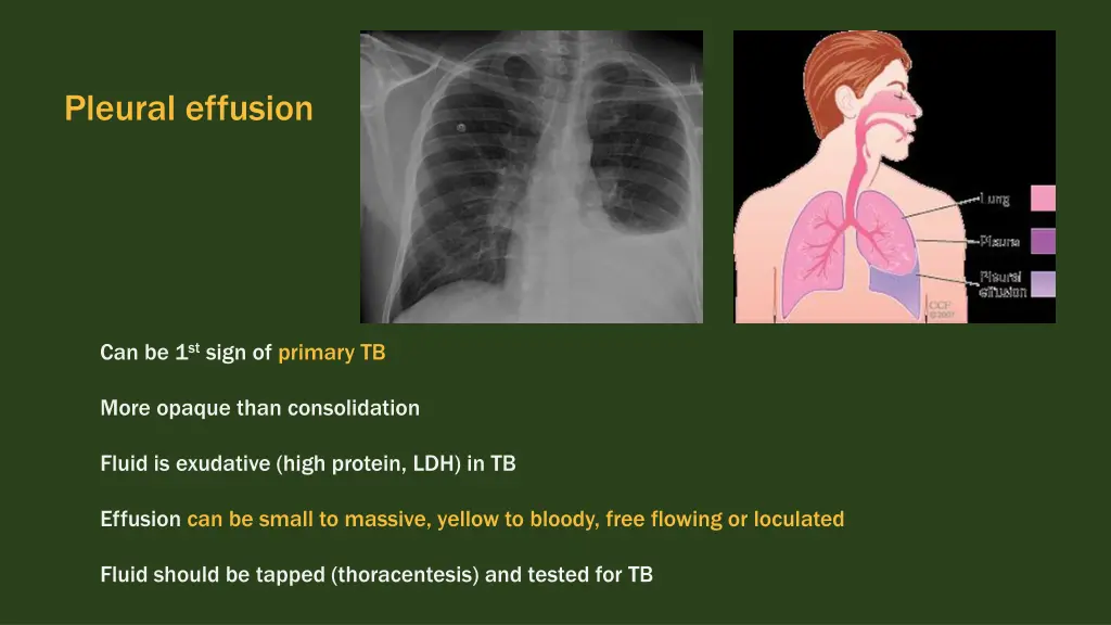 pleural effusion