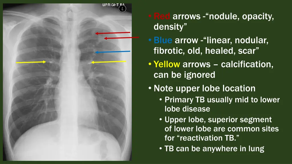 red arrows nodule opacity density blue arrow